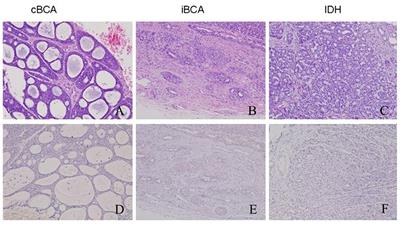 Myb Immunohistochemical Staining and Fluorescence in situ Hybridization in Salivary Rare Basaloid Lesions